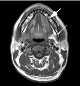 Fig. 2. The axial T1-weighted MRI image of the mouth floor shows aplasia of the left SMG (thin arrow) and compensatory hyperplasia of the left sublingual gland (thick arrow).