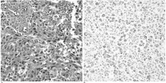 Fig. 4. Histopathologic findings of initial breast cancer and colonic metastasis. 