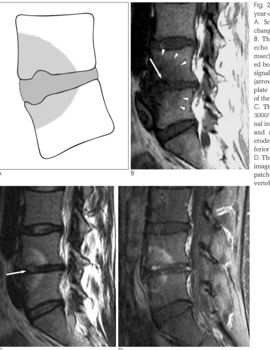 Fig.  2.  Modic type I change in a 37- 37-year-old woman with low back pain. 