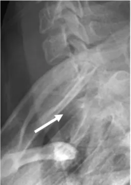 Fig. 1. A 19-year-old woman with spinal GCT. The swimmers lateral view radiograph of the cervical spine, which was  ac-quired with the patient with one arm up and one arm down, shows apparent collapse of the T1 vertebral body.