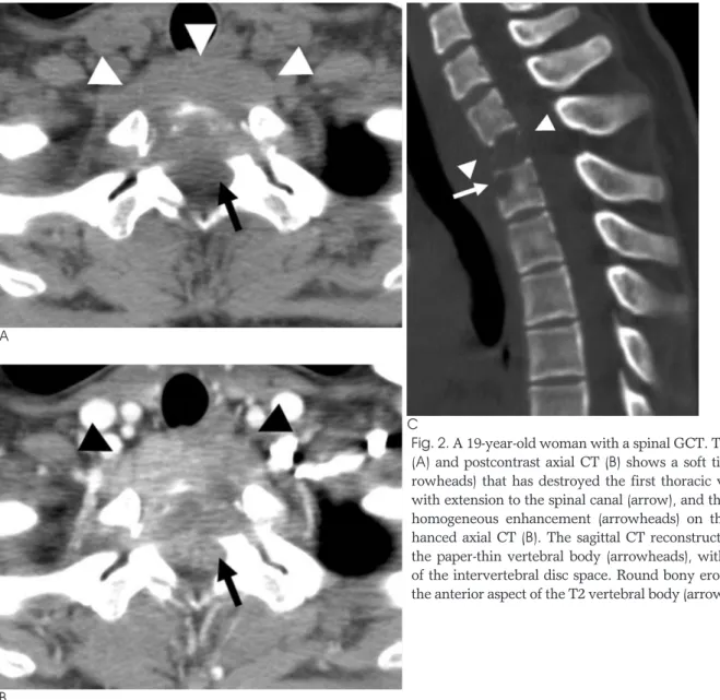 Fig. 2. A 19-year-old woman with a spinal GCT. The precontrast (A) and postcontrast axial CT (B) shows a soft tissue mass  (ar-rowheads) that has destroyed the first thoracic vertebral body with extension to the spinal canal (arrow), and this mass shows ho