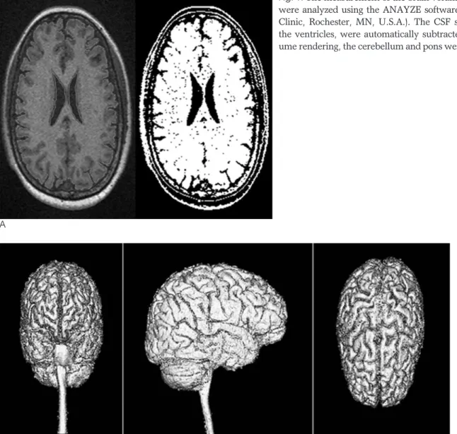 Fig. 1. The measurement of the brain volume. The MR scans were analyzed using the ANAYZE software package (Mayo Clinic, Rochester, MN, U.S.A.)