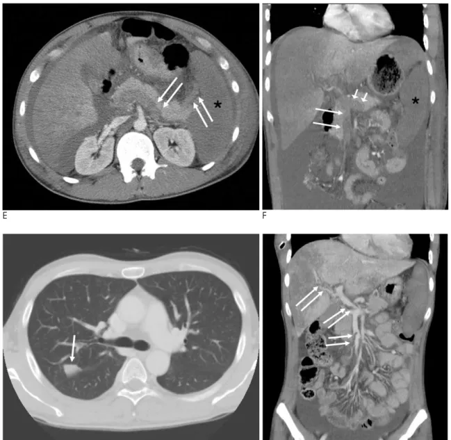 Fig. 1. E. A follow-up CT image obtained three days after the initial CT examinations demonstrates the progression of the splenic venous thrombus (arrows) and acute splenic infarction (asterisk).
