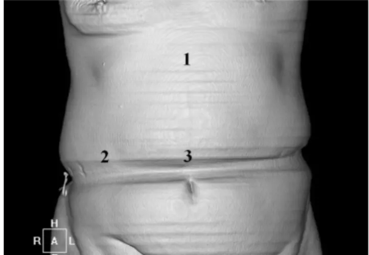 Fig. 1. Coronal volume- rendered image shows anatomic loca- loca-tion of ventral hernias.