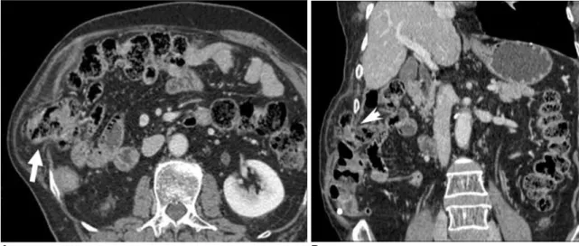 Fig. 4. 74-year-old man with palpable mass on right flank.