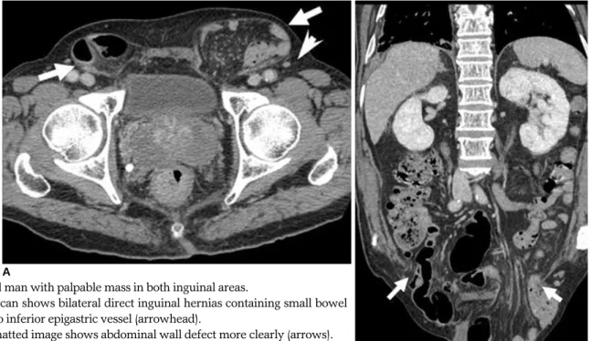 Fig. 7. 81-year-old man with palpable mass in both inguinal areas.