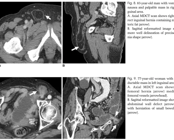 Fig. 8. 83-year-old man with vomiting, nausea and palpable mass in right  in-guinal area.