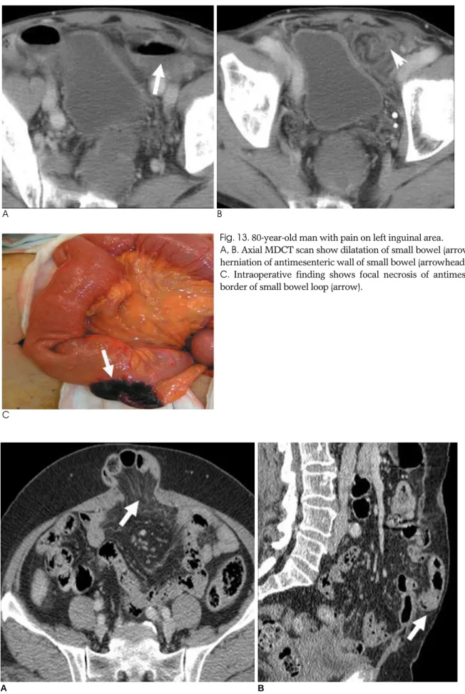 Fig. 13. 80-year-old man with pain on left inguinal area. 