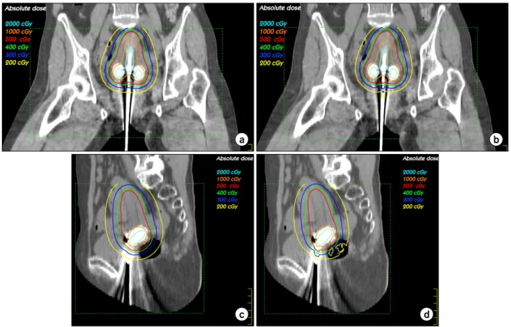 Fig.  10.  Isodose  distributions  on  the  coronal  and  sagittal  CT  images  with  different  dose  computation  methods,  while  500  cGy  isodose  lines  are  in  red
