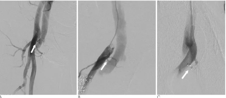 Fig. 1. A 65-year-old man presented with bruit at the right groin. 