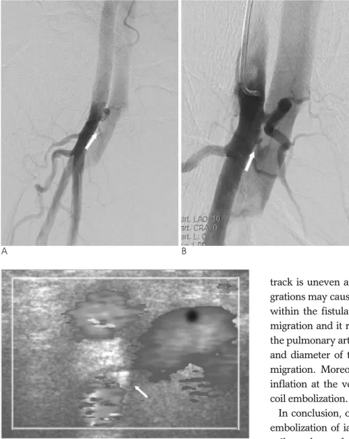 Fig. 2. A 74-year-old man presented a continuous bruit and a palpable thrill at the right groin