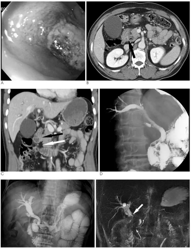Fig. 1. A 54-year-old man with ectopic opening of the common bile duct into the duodenal bulb.