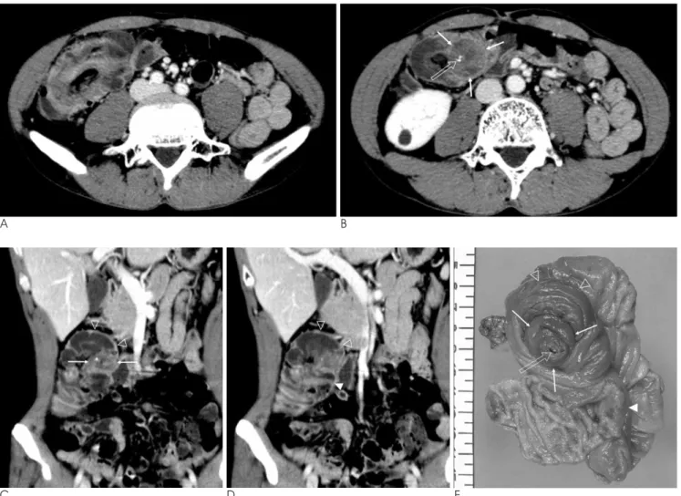 Fig. 1. Ileocecocolic intussusception due to acute appendicitis in a 42-year-old man.