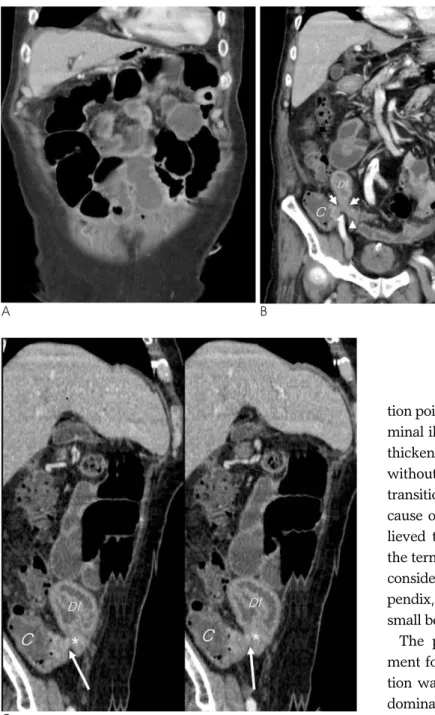 Fig. 1. Goblet cell carcinoid tumor of the appendix in an 80-year-old man. 