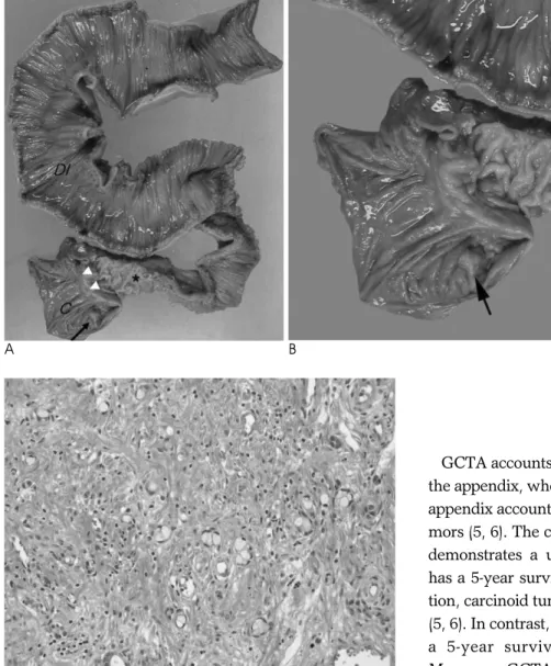 Fig.  2.  Pathologic findings of the re- re-sected specimen following right  hemi-colectomy.