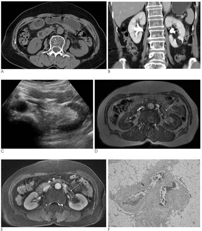 Fig. 1. A 67-year-old female with angiomyolipoma