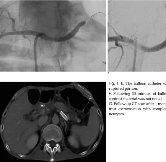 Fig.  1.  E. The balloon catheter was inflated to tamponade the ruptured portion. 