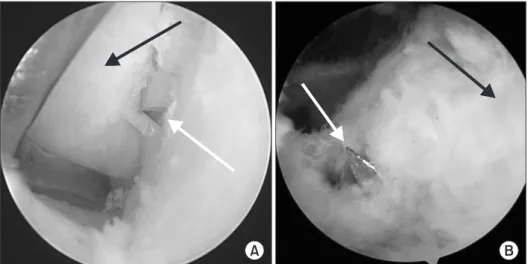 Figure 1. Guide pin placement in arthro  - -scopy (white arrows: guide pin, black arrows: 