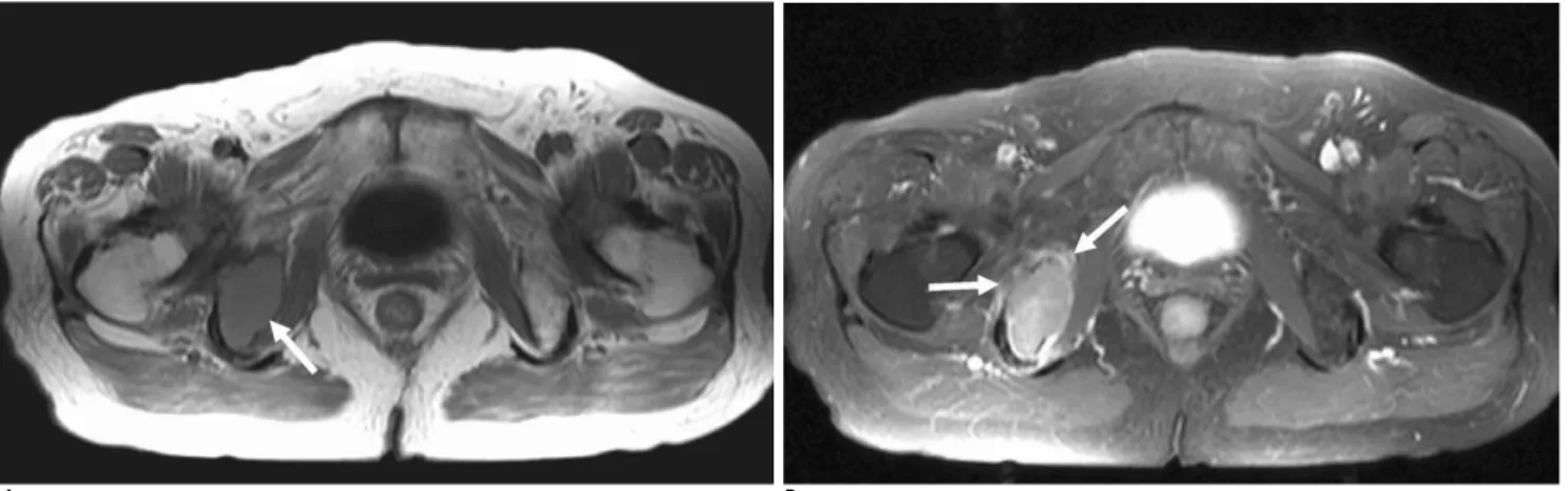 Fig. 3. A 76-year-old female with plasmacytoma in the right ischium.
