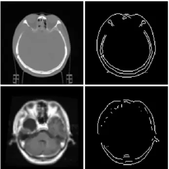 Fig.  7.  Results  of  extracted  contours  of  computed  tomography  and  registered  T1  weighted  magnetic  resonance  image  to  evaluate  registration  accuracy.