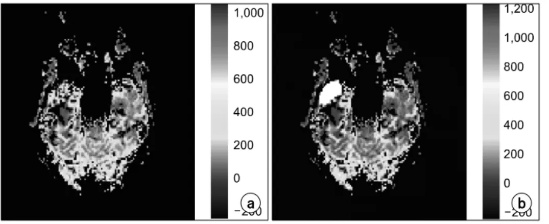Fig.  10.  The  check  of  the  determined  region  of  interest  (ROI)  on  the  rCBV  maps