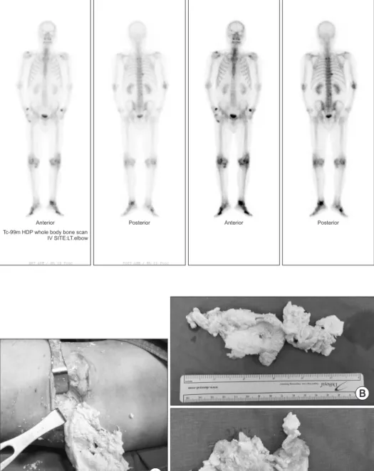 Figure 4. Tc-99m hydroxydiphosphonate  (HDP) whole body bone scan showed  a soft tissue mass with faint increased  uptake behind both knee joints
