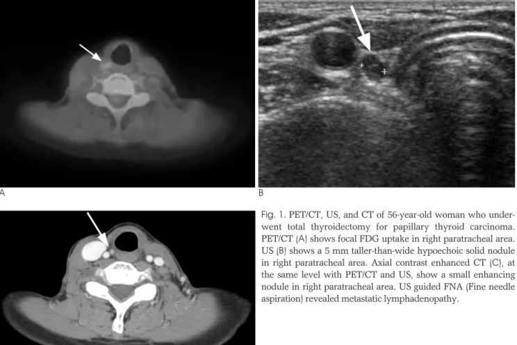 Fig. 1. PET/CT, US, and CT of 56-year-old woman who under- under-went total thyroidectomy for papillary thyroid carcinoma.