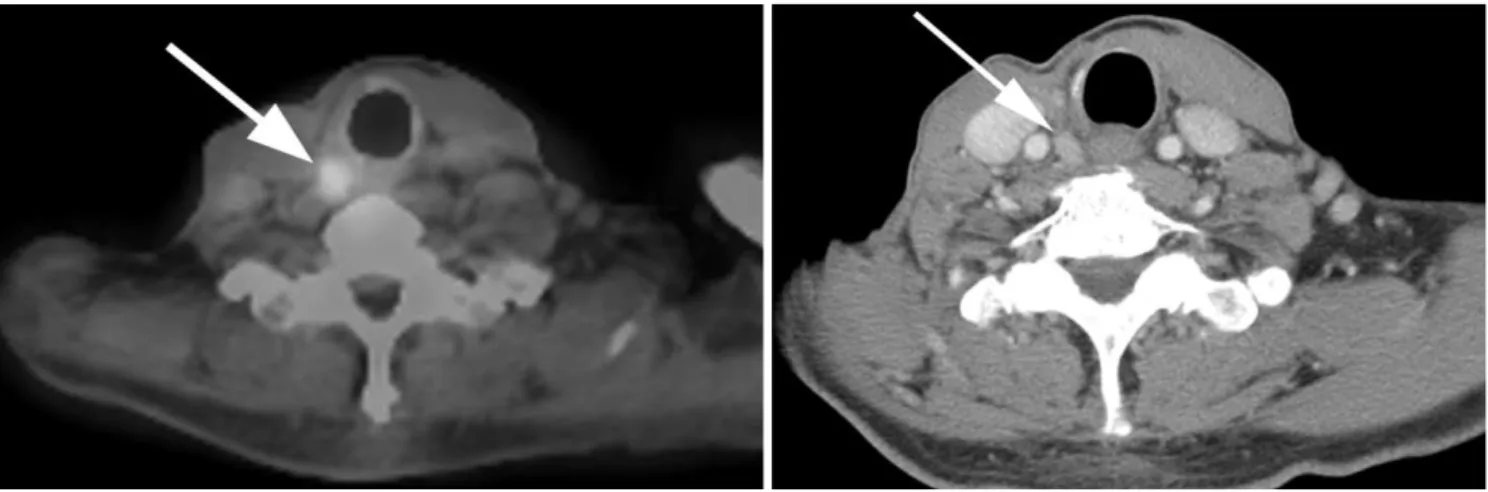 Fig. 3. PET/CT, US, and CT of 66-year-old man who underwent total thyroidectomy and neck dissection for papillary thyroid carci- carci-noma