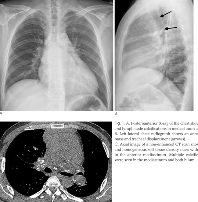 Primitive Neuroectodermal Tumor of Mediastinum in an Adult: A Case Report