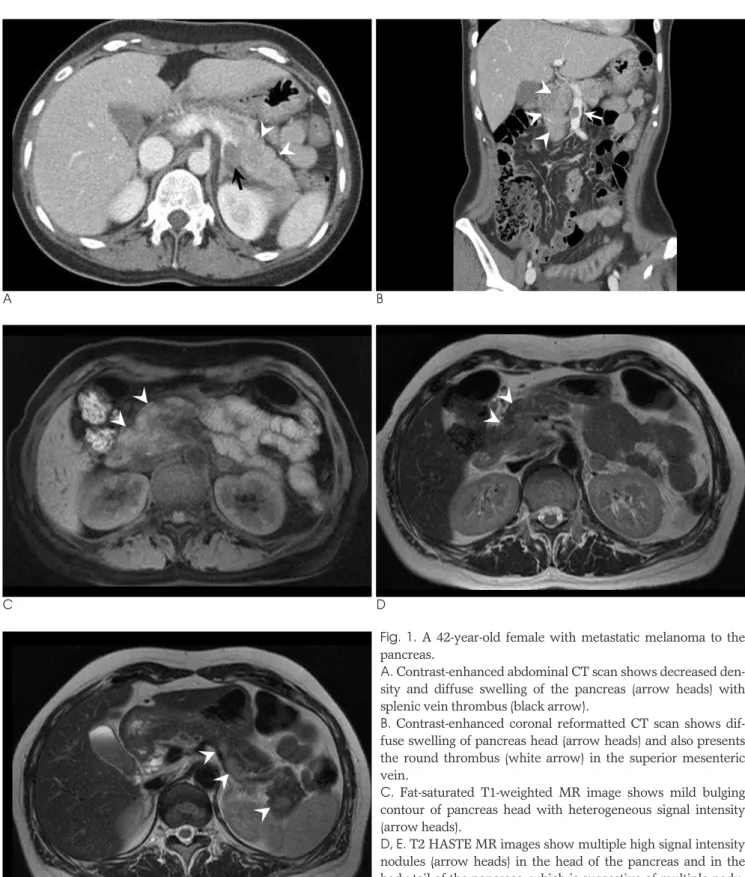 Fig.  1. A 42-year-old female with metastatic melanoma to the pancreas.