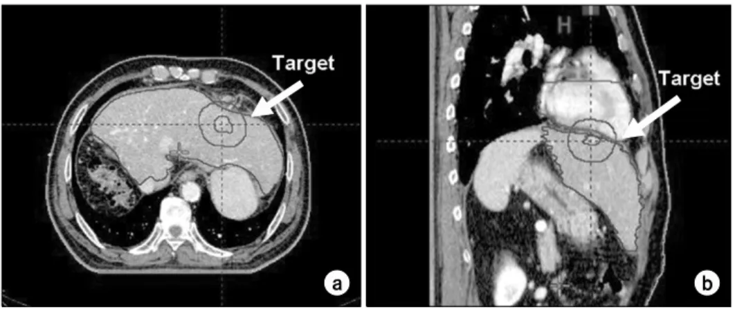 Fig.  1.  Position  of  the  target  in  Liver  cancer:  (a)  axial  view  of  tumor  location,  (b)  sagittal  view  of  tumor  location.해  발생한  MLC의  동작과는  달리  최적화를  위해  조절점(control  point)이라 불리는 177개의 무작위로 발생하는 각도로 360o의 아크를 나누어 각 조절점에서 MLC위치의 순차적인  최적화