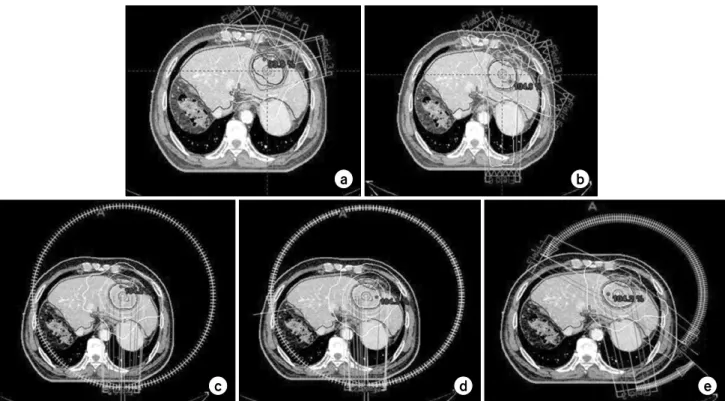 Fig.  3.  A  screen-shot  of  the  5  kinds  of  Plan's  dose  distribution  in  liver  cancer:  (a)  Using  3  fields  in  3D  plan,  (b)  using  5  fields  in  IMRT  plan,  (c)  double  arcs  plan,  (d)  limited  triple  arcs  plan,  (e)  multiple  arcs 