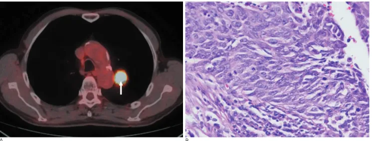 Fig. 2. Well differentiated squamous cell carcinoma in a 66-year-old male.