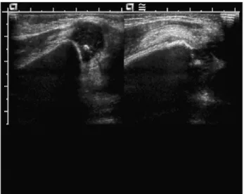 Figure 4. Serial radiographs of the  right femur show remodeling of angular  deformity at 1 month (A), 5 months (B),  and 1 year and 5 months (C) after delivery.