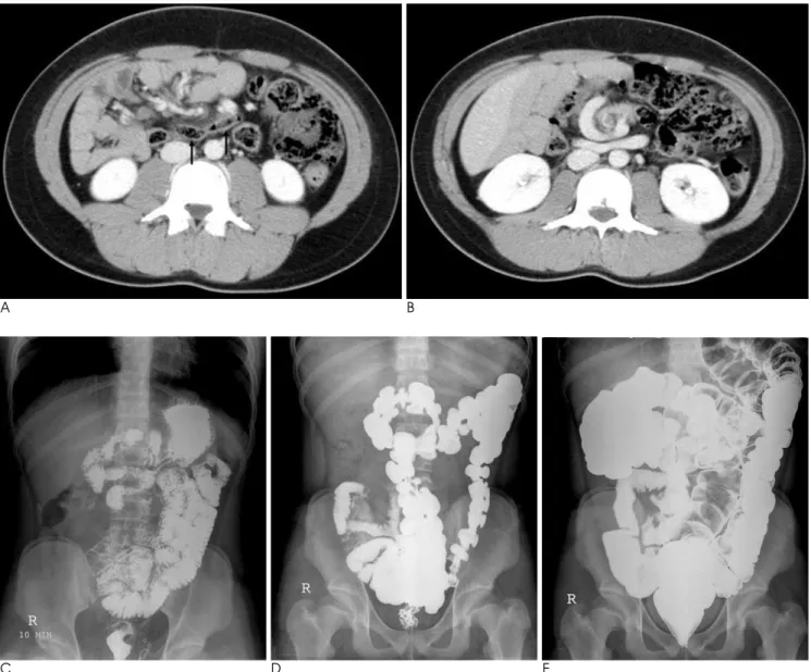 Fig. 2. A 16-year-old man with reversed intestinal rotation.