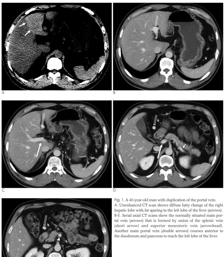 Fig. 1. A 40-year-old man with duplication of the portal vein.