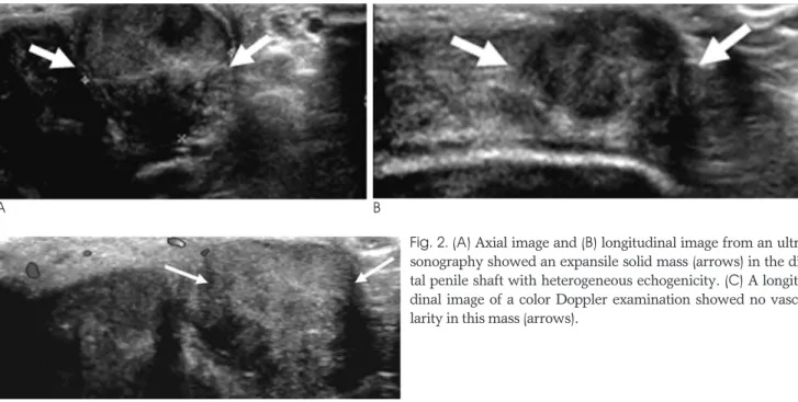 Fig. 1. Appearance of penis at presentation. A non-mobile hard mass (arrows) was palpated on the distal shaft of left penis.