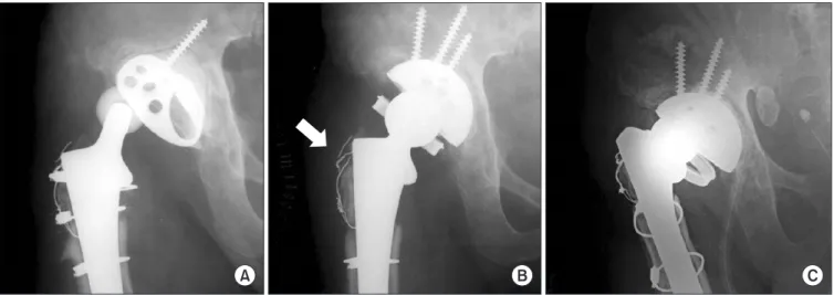 Figure 1. (A) Radiograph of a 68-year-old male shows dislocation of the right hip. He underwent two operations on the same hip and 10 times of  dislocation after previous surgery