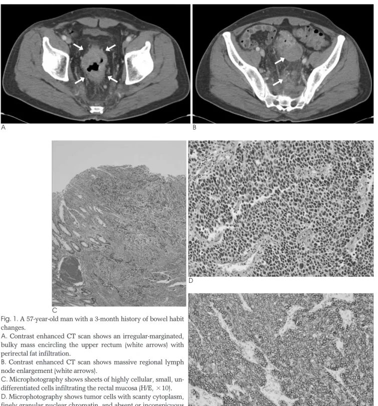 Fig. 1. A 57-year-old man with a 3-month history of bowel habit changes.