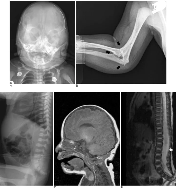 Fig. 1. Plain radiograph and MR images of the infant.