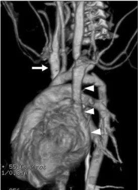 Fig.  6.  Azygos venous system in prevertebral space in a 56- 56-year-old woman.