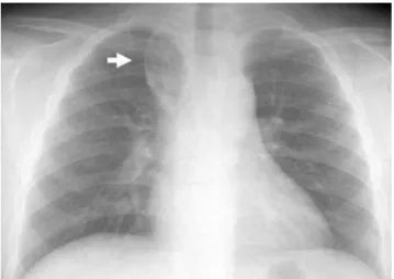 Fig. 9. Azygos lobe in a 65-year-old man.