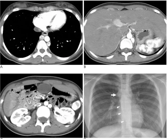 Fig. 10. Hemiazygos and azygos continuation of the double inferior vena cava in a 15-year-old girl.