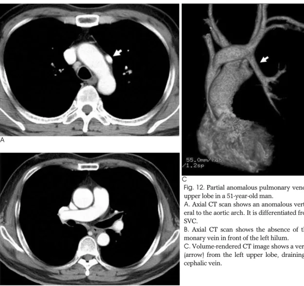 Fig. 12. Partial anomalous pulmonary venous return of the left upper lobe in a 51-year-old man