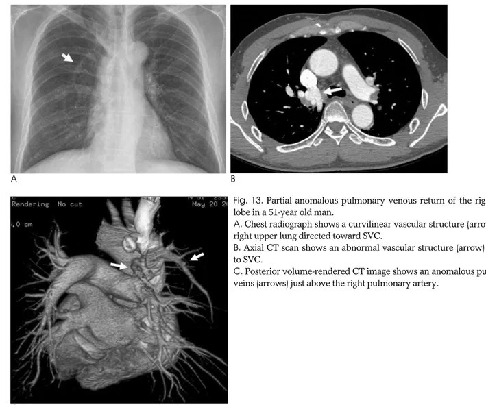 Fig. 13. Partial anomalous pulmonary venous return of the right upper lobe in a 51-year old man