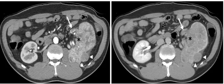Table 3. MDCT Diagnostic Performance of the Two Readers for Predicting the T-staging of 144 Renal Cell Carcinomas