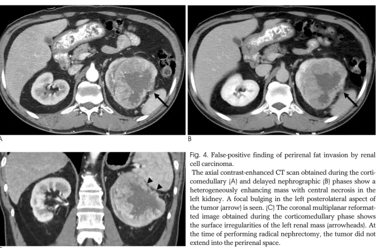Table 3 presents the MDCT diagnostic performance of the two readers for predicting the T-staging in the 144 RCCs