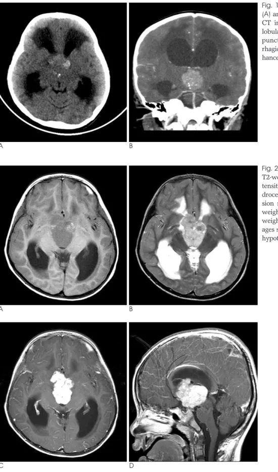 Fig.  1.  A,  B.  The non-enhanced axial (A) and contrast enhanced coronal (B) CT images show a well-demarcated, lobulated, solid mass with multiple punctate calcifications and  hemor-rhagic foci