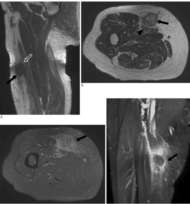 Fig. 1. A. A sagittal T1-weighted spin-echo MR image shows a round, partially ill-marginated hypointense mass (arrow) in the right thigh