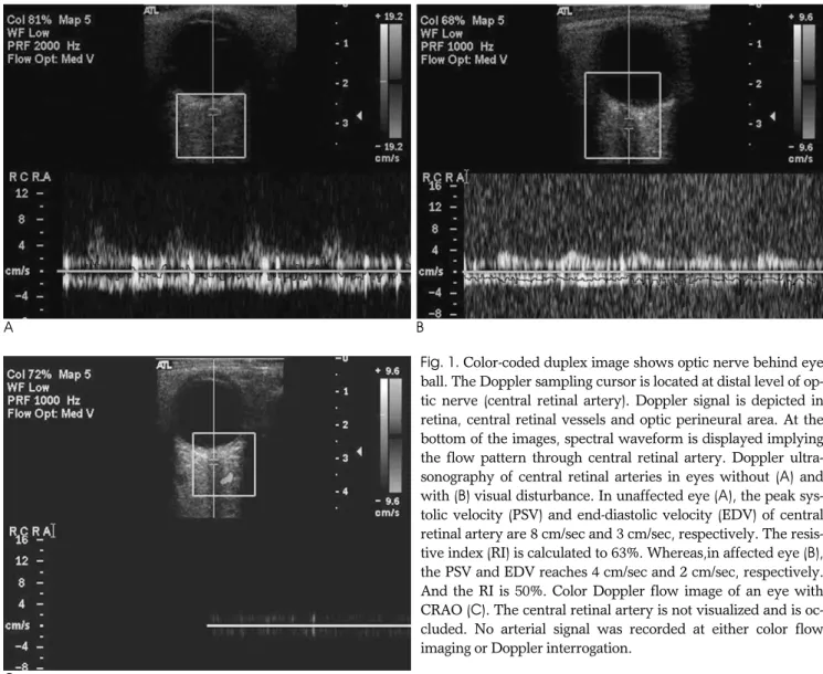 Fig. 1. Color-coded duplex image shows optic nerve behind eye ball. The Doppler sampling cursor is located at distal level of  op-tic nerve (central retinal artery)
